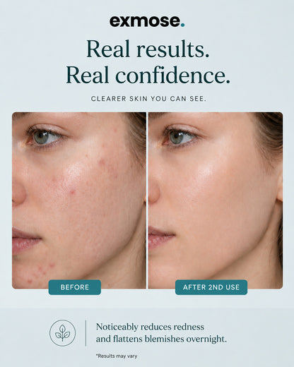exmose ClearDot™